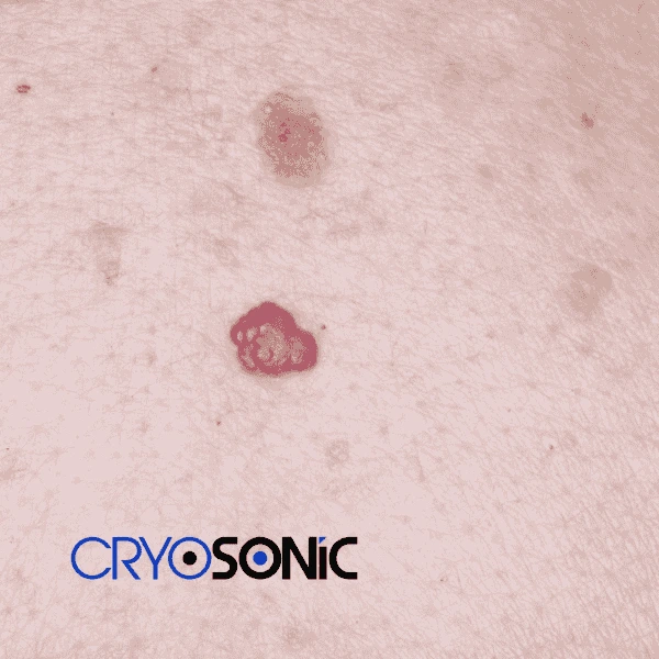 Looking for pain free cherry angioma removal treatment Blackpool? Call our team today! Blackpool