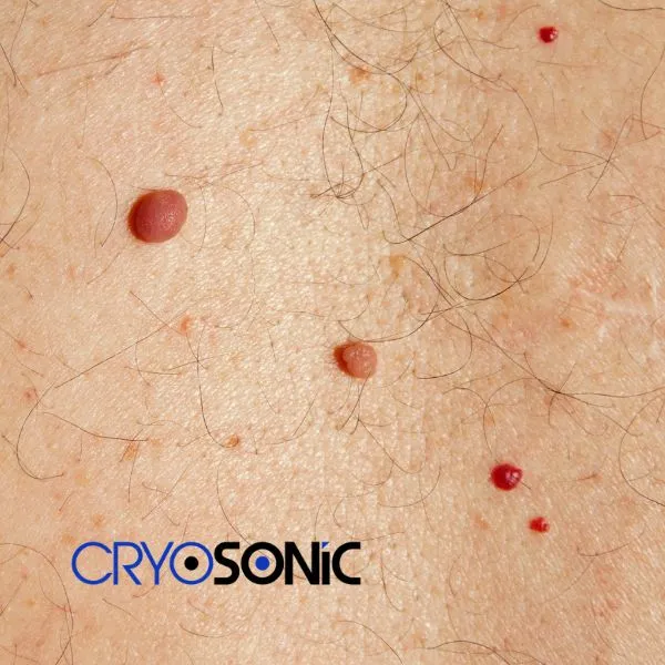 get cherry angioma removal treatment today! Blackpool