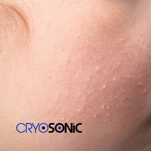 Are you looking for milia removal treatment? Contact our team today Blackpool