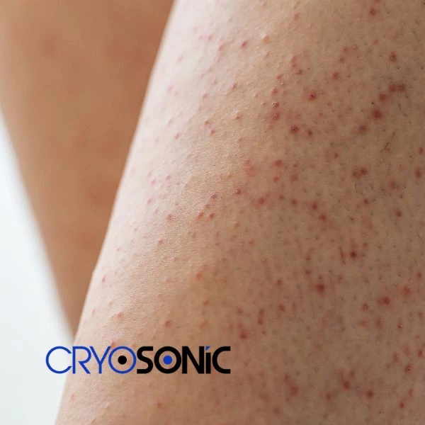 Looking for Seborrhoeic Keratosis removal Blackpool treatment? Call our consultants today in Blackpool