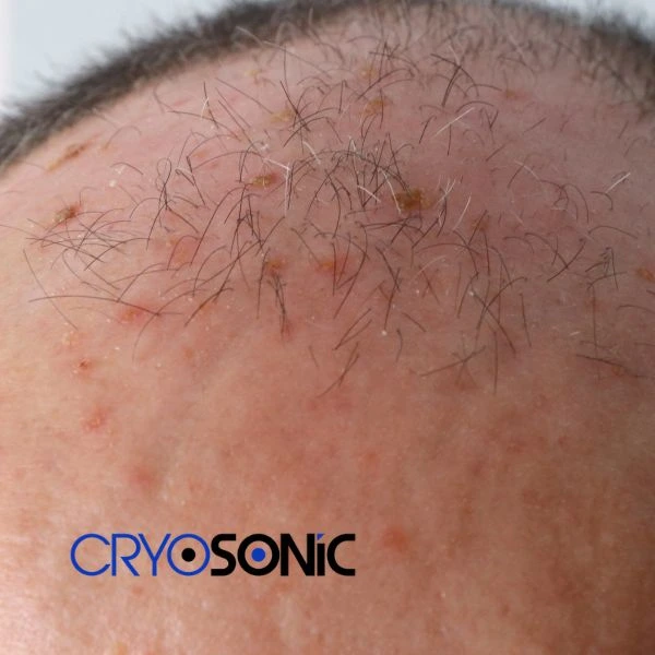 Access Seborrhoeic Keratosis removal from the comfort of your own home! Call us today in Blackpool