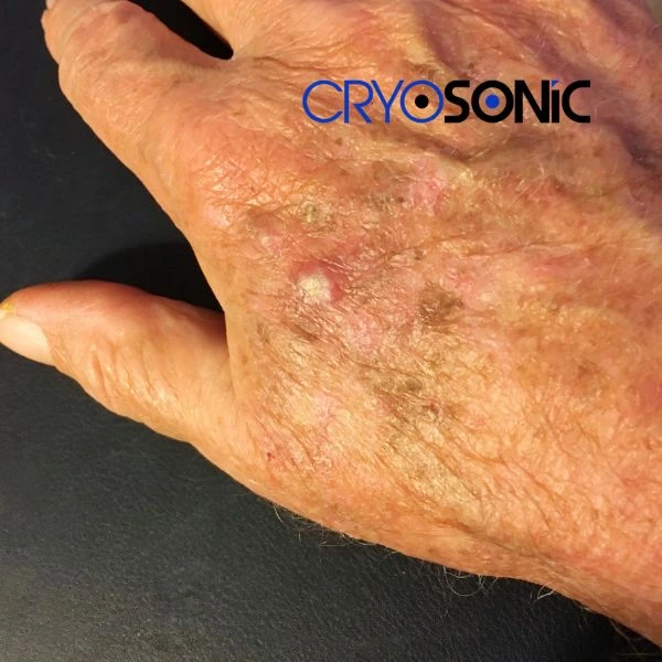 Understand more about actinic keratosis treatment today Blackpool