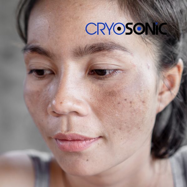 Ready to start age spots removal? Contact our team today in Blackpool