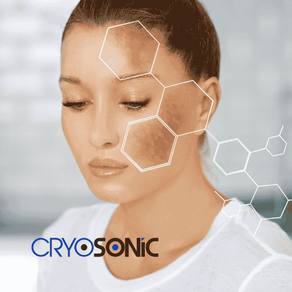 Are you looking for age spot removal treatment? Contact Cryosonic today in Blackpool