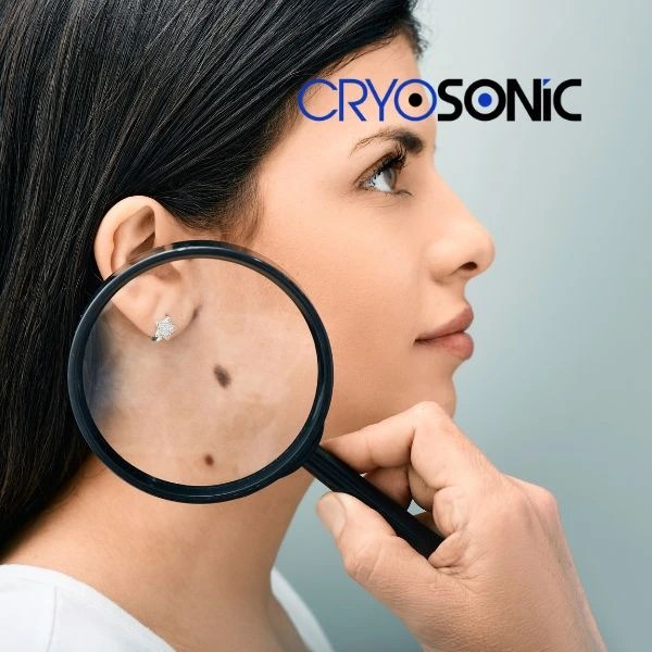 Do you want to learn more about benign moles removal treatment? Call our team today Blackpool