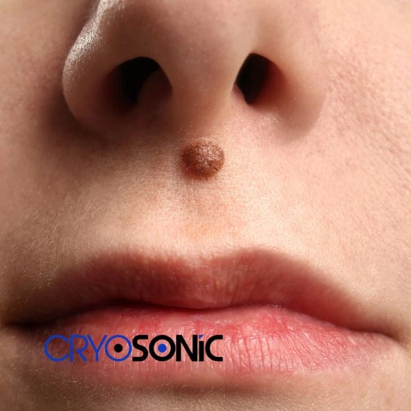 Start your benign moles removal treatment today Blackpool