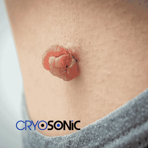 Book your skin tags removal Blackpool from comfort of your own home! Blackpool