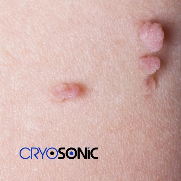 Are you looking for fast effect skin tag removal Blackpool? Book in NOW! Blackpool