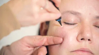 CryoPen device treating milia Blackpool cysts on the skin safely and precisely Blackpool