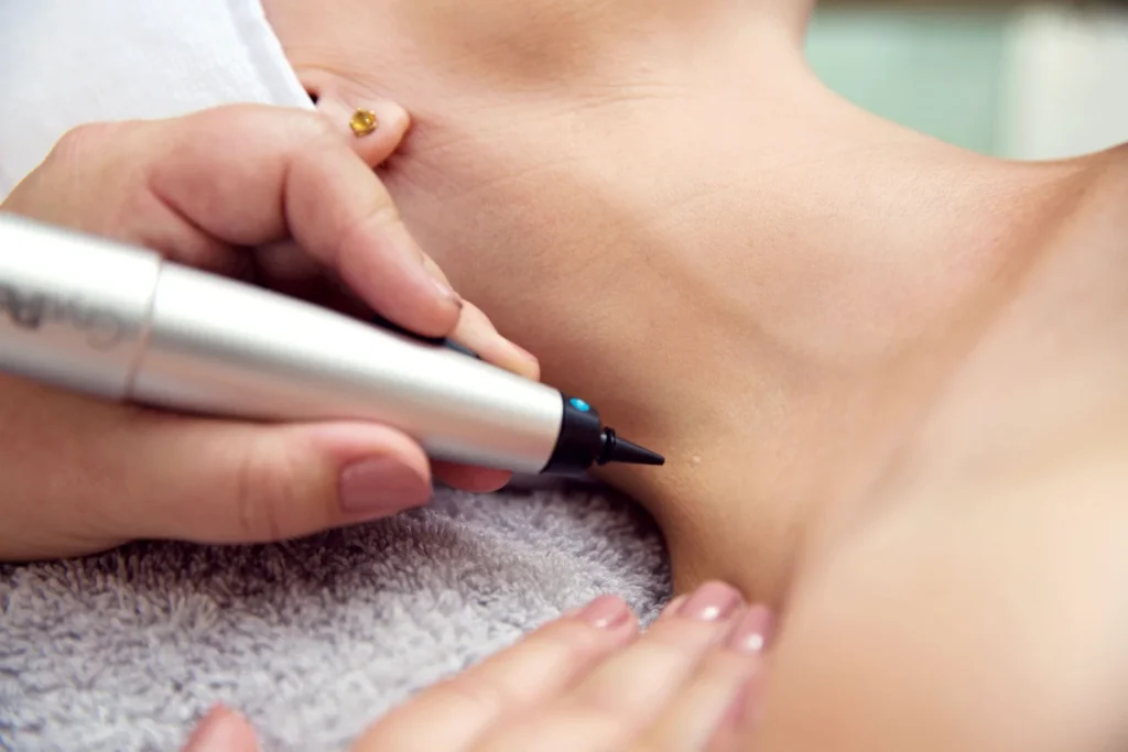 CryoPen precisely treating Molluscum Contagiosum lesions, showing safe and effective removal for faster healing by Cryosonic Blackpool