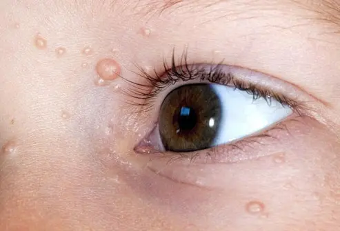 CryoPen treating persistent Molluscum Contagiosum Blackpool lesions Blackpool