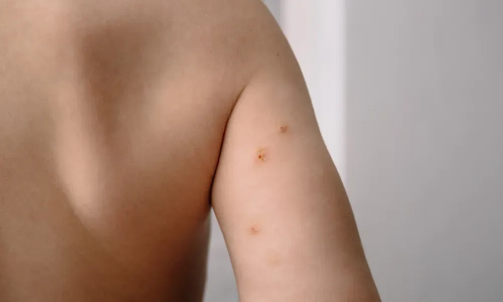 CryoPen treating Molluscum Contagiosum Blackpool professionally, highlighting safe and precise lesion removal for improved skin and confidence Blackpool