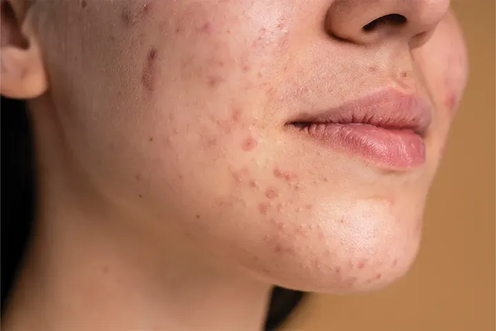 CryoPen precisely removing Skin Tags (fibroepithelial polyps), showing safe and effective treatment for smoother, clearer skin Blackpool