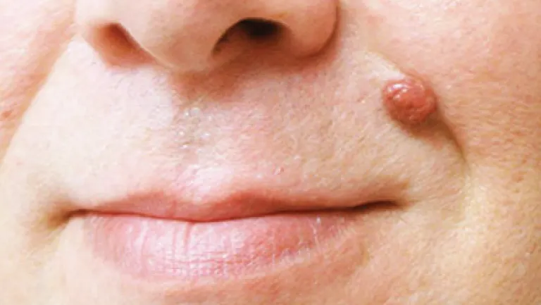 CryoPen safely removing Skin Tags Blackpool, showing minimal recurrence risk and precise treatment for smoother, clear skin by Cryosonic Blackpool