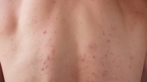 CryoPen treating Blackpool Molluscum Contagiosum lesions safely and precisely, illustrating answers to common patient FAQs Blackpool