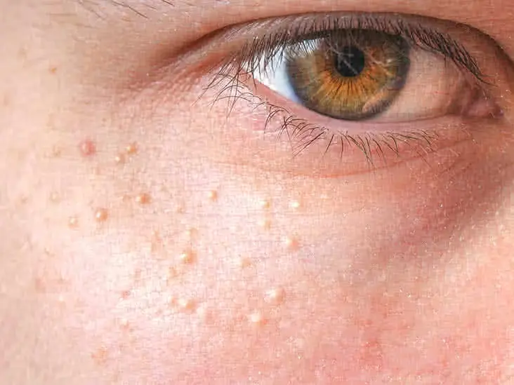 Close-up of skin showing milia Blackpool, small keratin-filled cysts on the face Blackpool