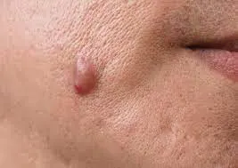 common causes of Skin Tags Blackpool formation, including friction, genetics, and hormonal changes Blackpool